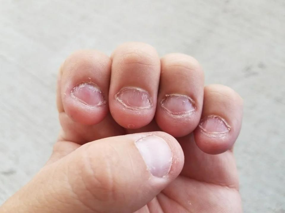 close up of bitten fingernails