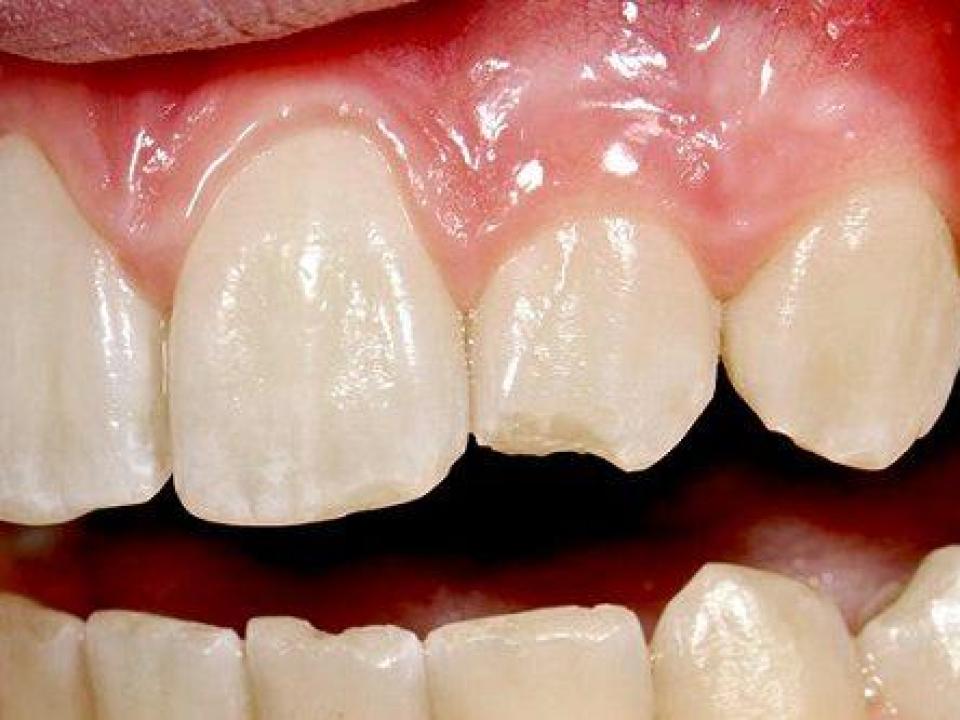 cracked tooth from nail biting