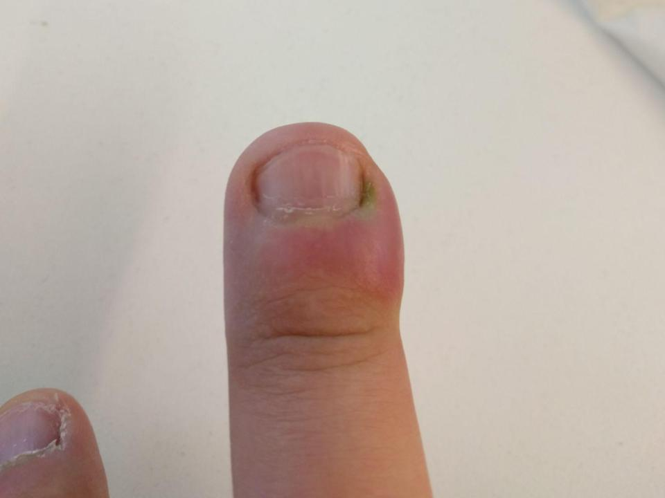 finger infection caused by biting nails
