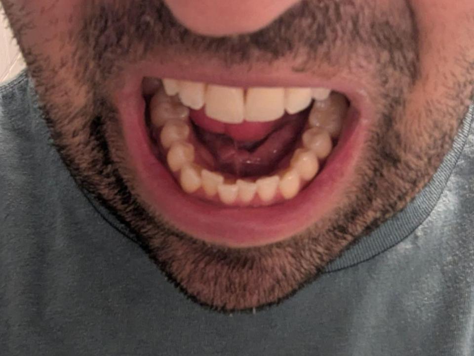 shifting teeth from nail biting