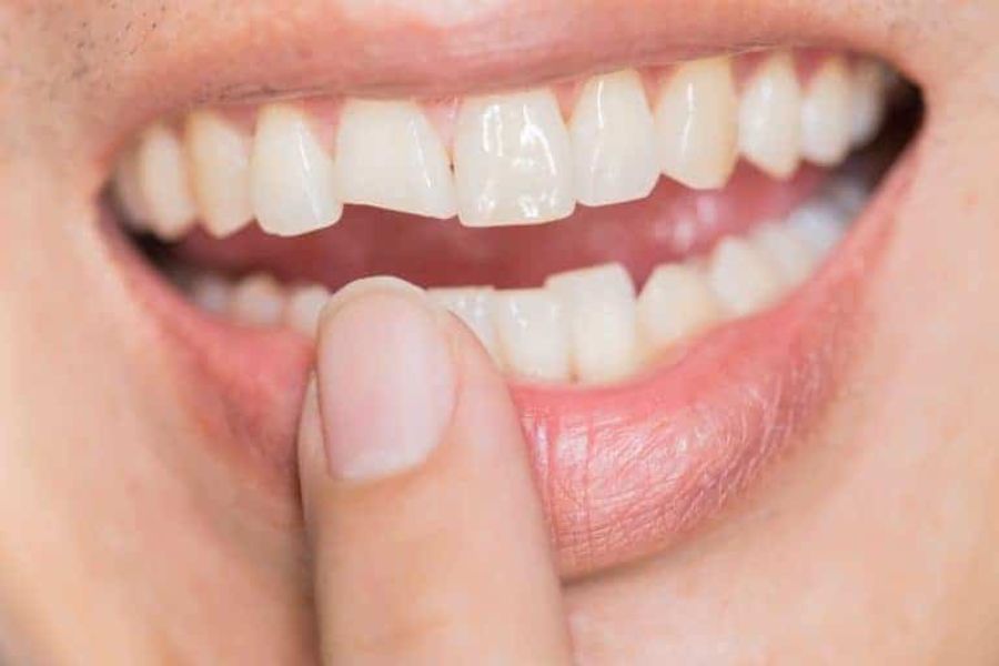 chipped tooth from nail biting