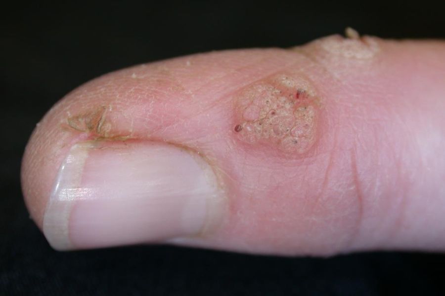 finger with periungual warts